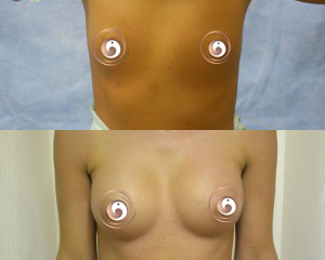 Breast Augmentation & Implants