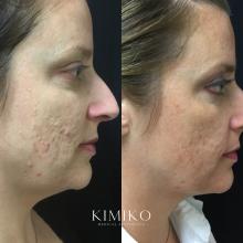 microneedling results acne scars