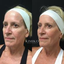 ultherapy skin tightening before and after pictures