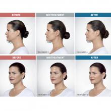 kybella for chin fat
