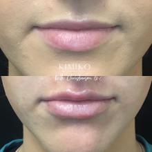 lip filler tulsa oklahoma juvederm lip augmentation