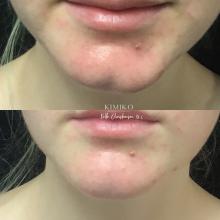 chin filler tulsa oklahoma before and after 