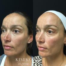 woman before and after diamond glow treatment