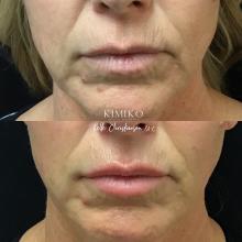 smokers lines lip correction tulsa before and after