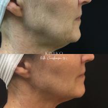 liquid facelift in tulsa before and after photos
