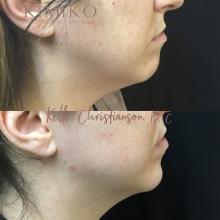 botox chin correction before and after tulsa 