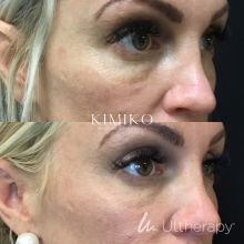 ultherapy for under eyes 