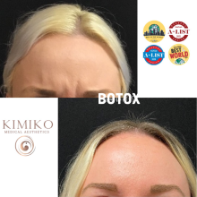 Botox in Forehead before and after