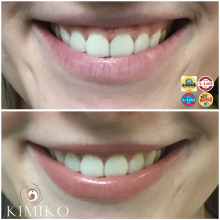 Botox for Gummy Smile Before and After