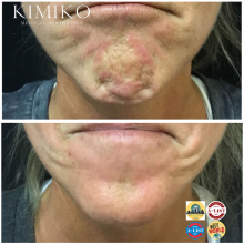 Botox for Chin Before and After
