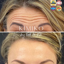 Jeuveau for forehead lines before and after 
