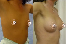 Dr. Tedesco Breast Implant Cosmetic Surgery Tulsa