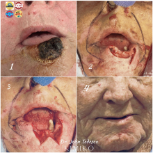 squamous cell carcinoma removal & reconstruction 