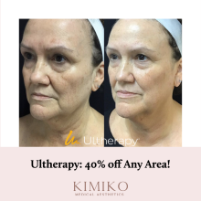 40% off Ultherapy - Black Friday