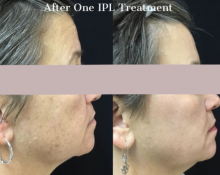 Give Thanks: Buy IPL for Face, Get Neck or Hands for Free