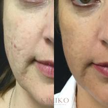 microneedling and prp results tulsa 