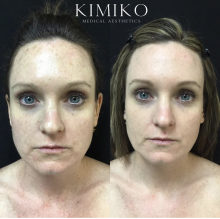 before and after intense pulsed light 
