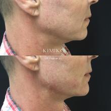 men jawline chin enhancement tulsa ok before and after