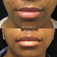 before and after of 2 syringes of lip filler