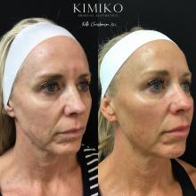 facelift before after tulsa