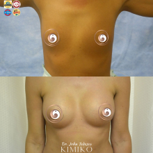 Breast Augmentation Surgery Tulsa