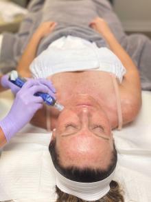 photo of woman getting microneedling treatment 