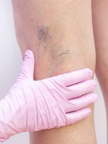 photo of legs with spider veins